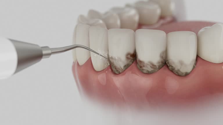Trusted Wisdom Tooth Removal service in Bannockburn, IL - Dentist Open Now